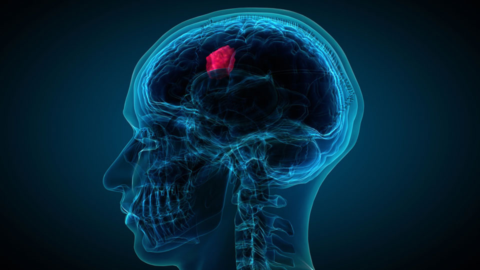 New hope for brain cancer patients 脑肿瘤患者的新希望